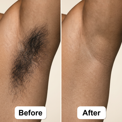 Vanta Pulse IPL