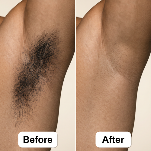 Vanta Pulse IPL